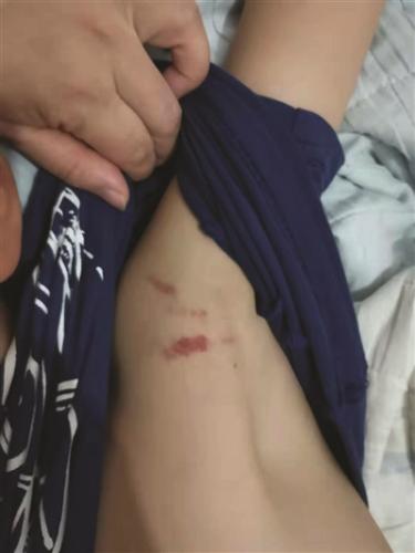 后来,我在给儿子穿衣服的时候就发现他胳肢窝处有多处明显的血痕,肋骨